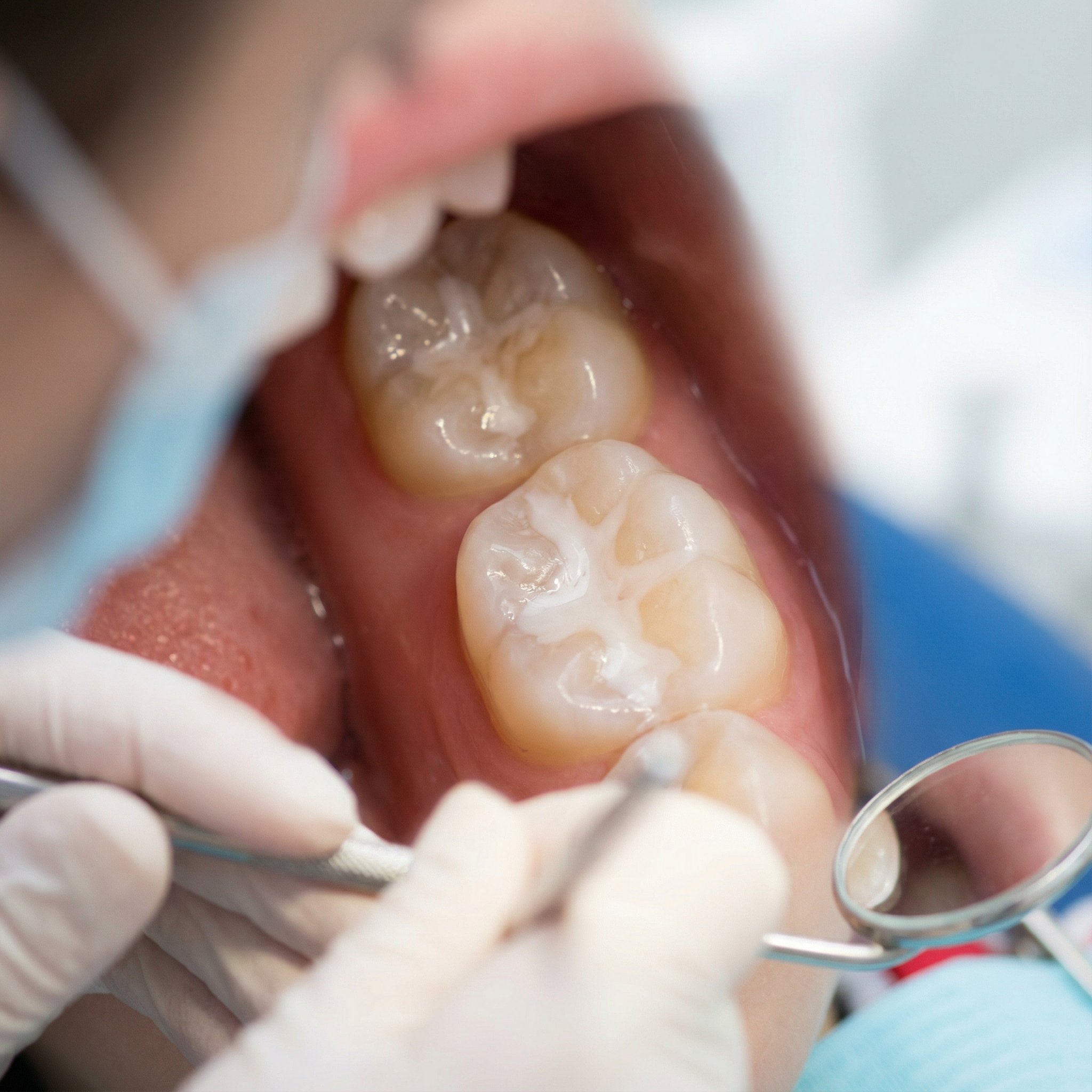 Close-up view of dental sealants protecting children's back molars from cavities