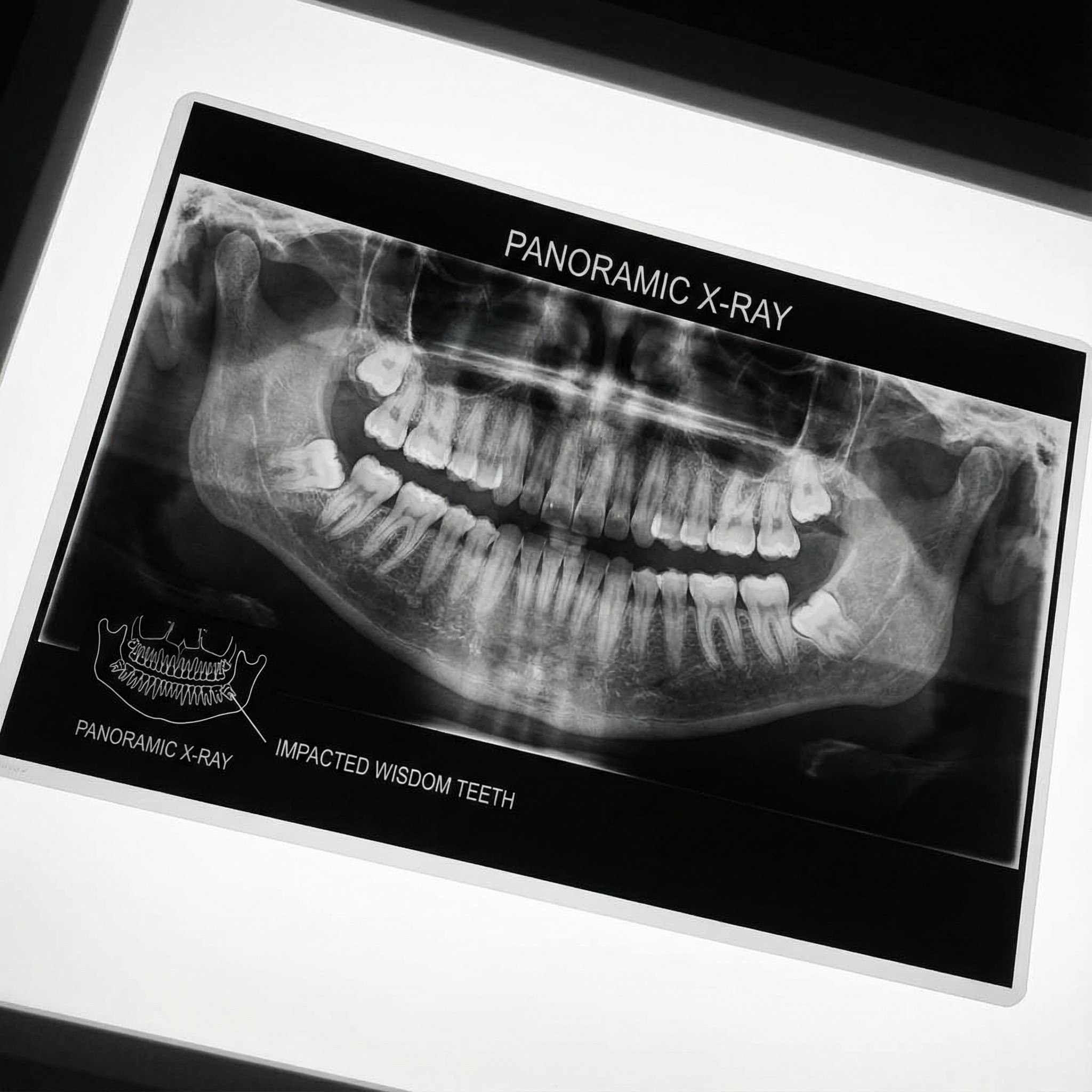 Panoramic dental x-ray showing impacted wisdom teeth